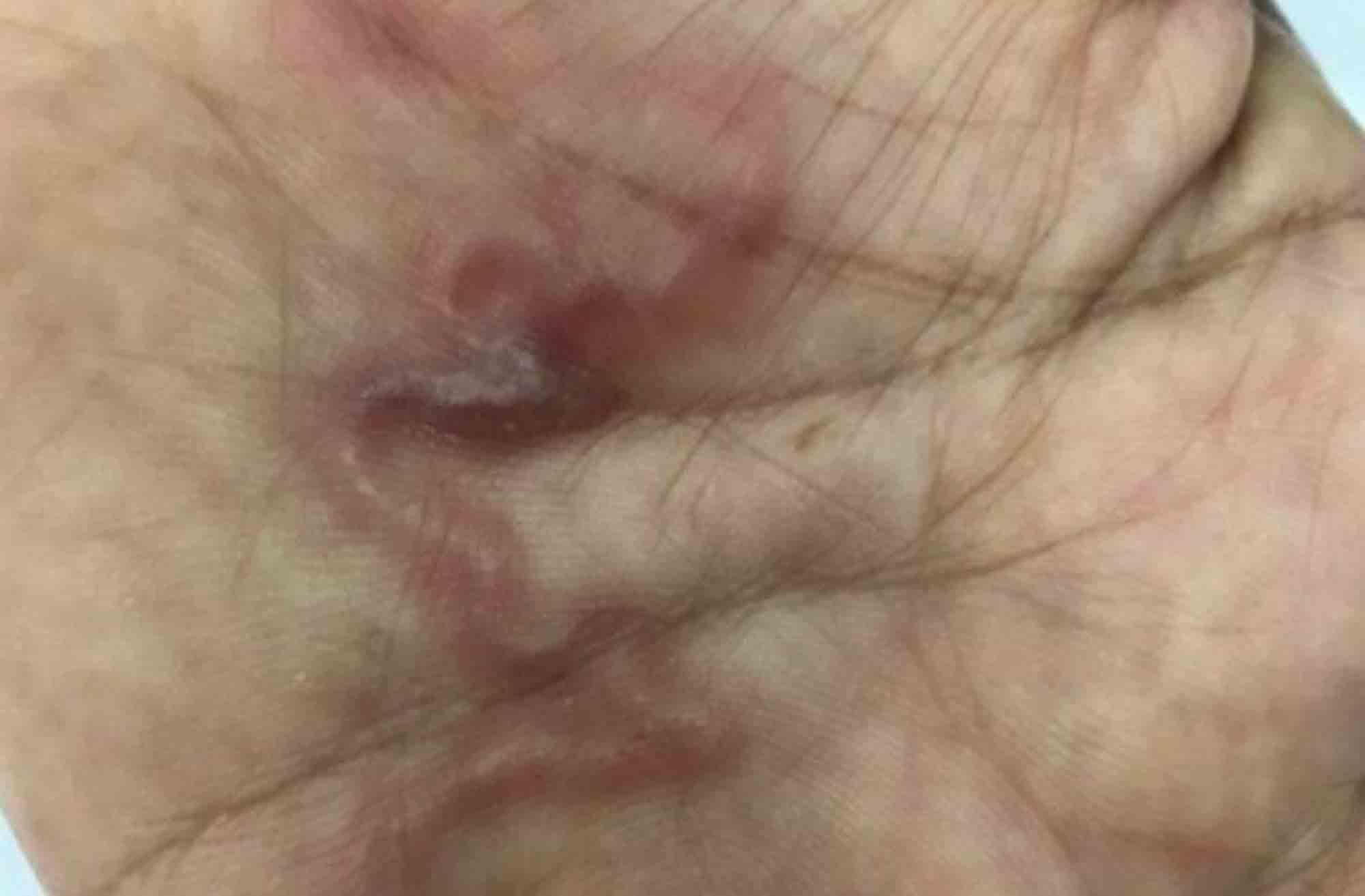 Parasites swarming beneath skin of Vietnamese woman